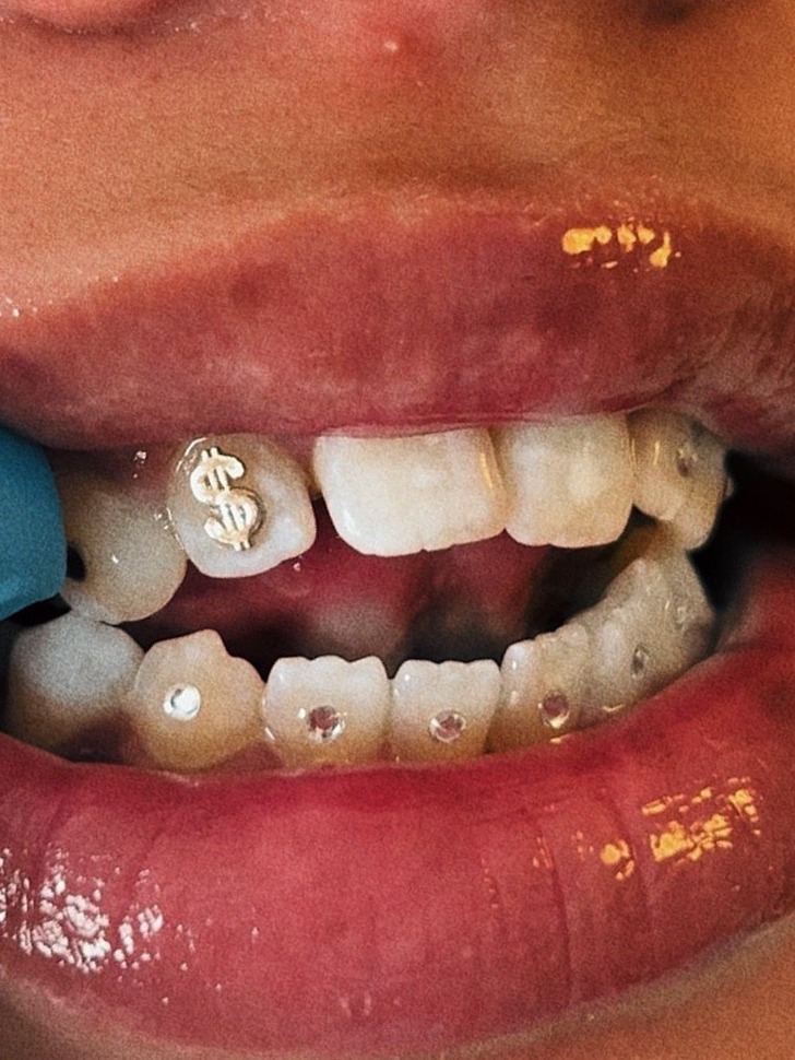 Toothgem in de vorm van een dollarteken, net geplaatst